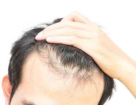 Male Hair Loss | HairMD, Pune