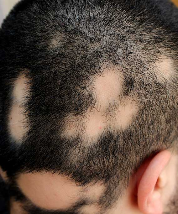 Scarring Alopecia | HairMD, Pune