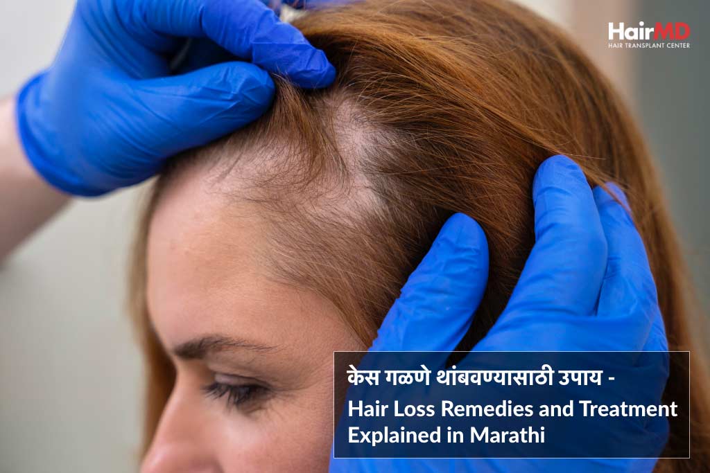 केस गळणे थांबवण्यासाठी उपाय - Hair Loss Remedies and Treatment Explained in  Marathi