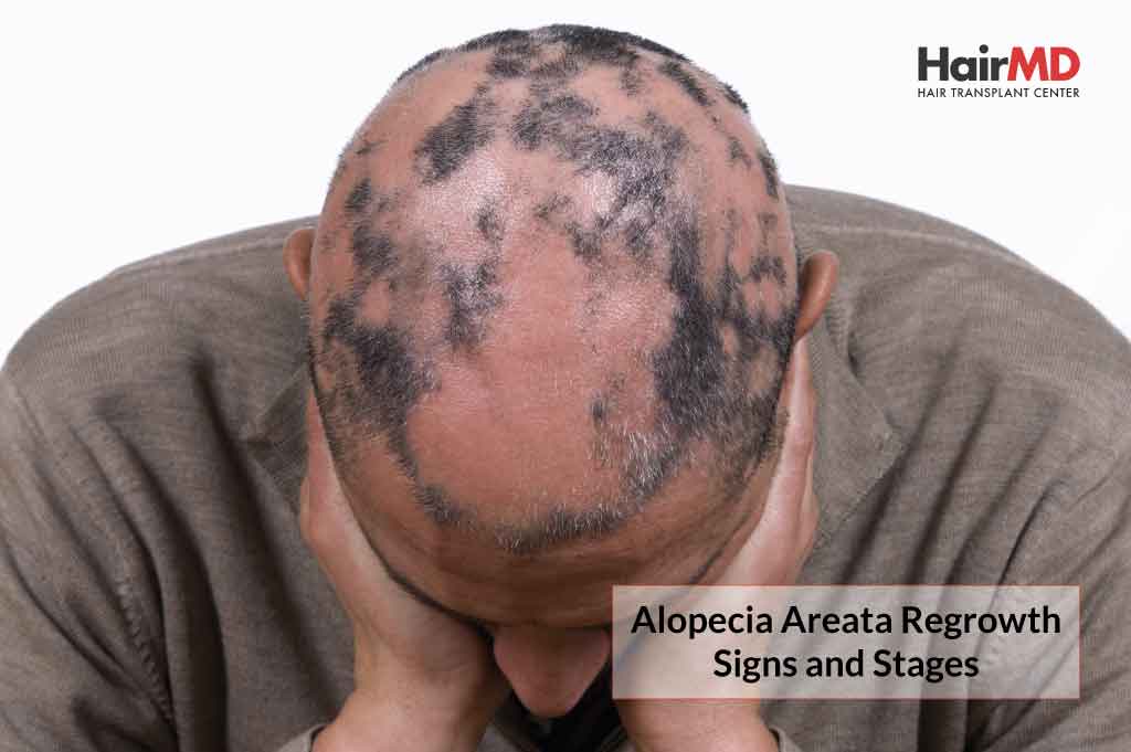Alopecia Areata Regrowth Signs and Stages