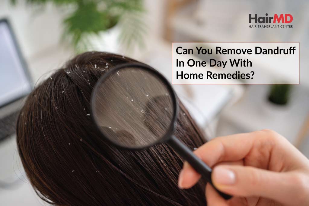 Can You Remove Dandruff in One day with Home Remedies?
