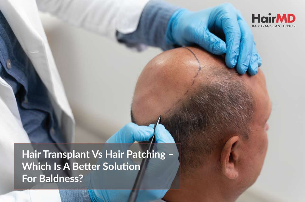 Hair Transplant vs Hair Patching – Which is a Better Solution for Baldness?
