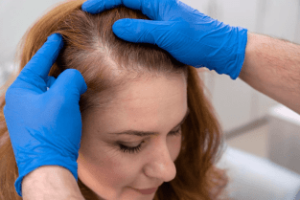 Treating Hair Loss in Women: Early Stage of Female Pattern Baldness