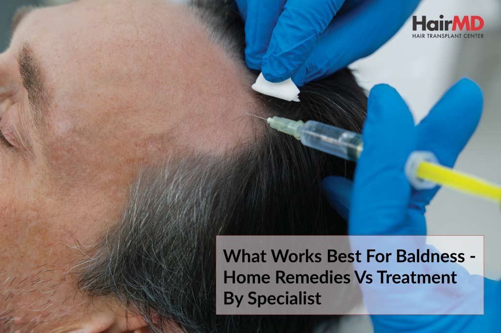 What Works Best for Baldness - Home Remedies Vs Treatment by Specialist