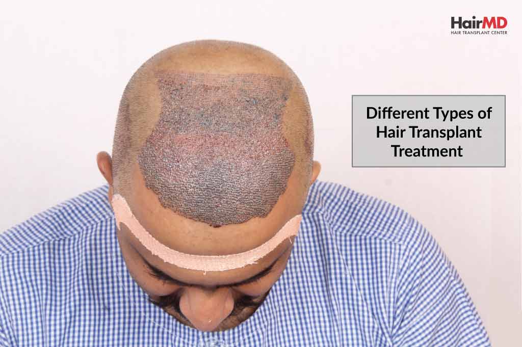 Different Types of Hair Transplant Treatment