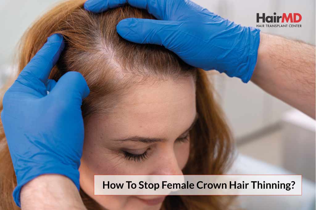 How to Stop Female Crown Hair Thinning?