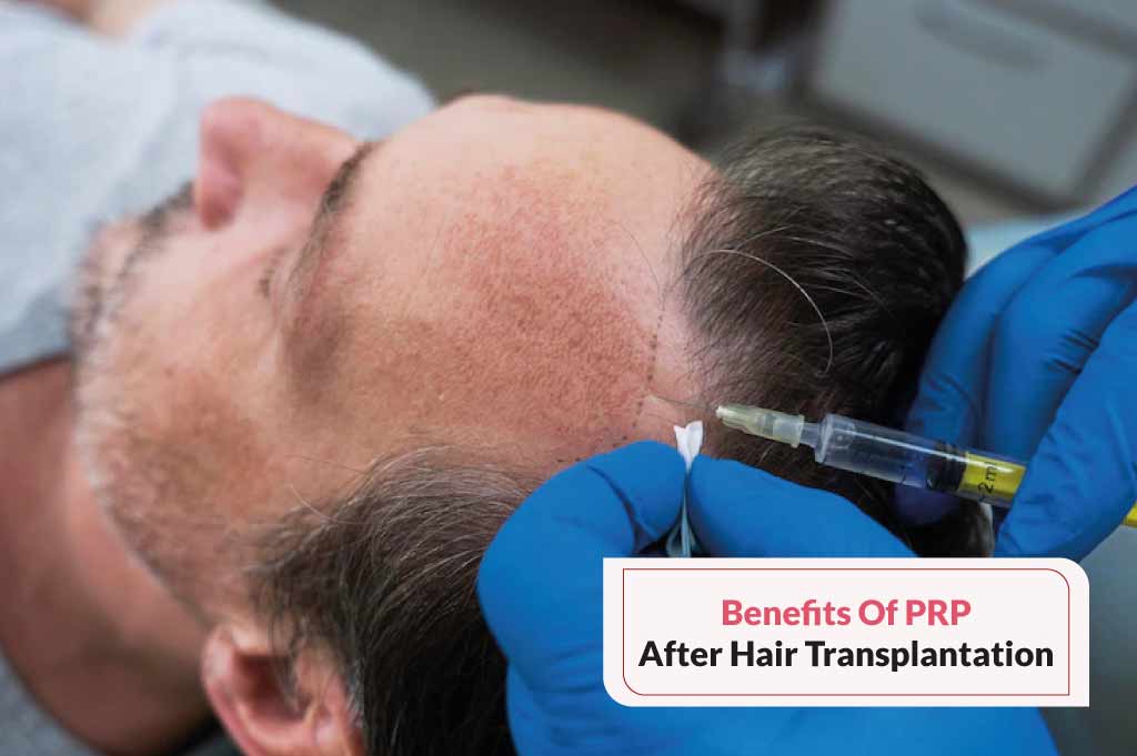 Benefits of PRP after Hair Transplantation