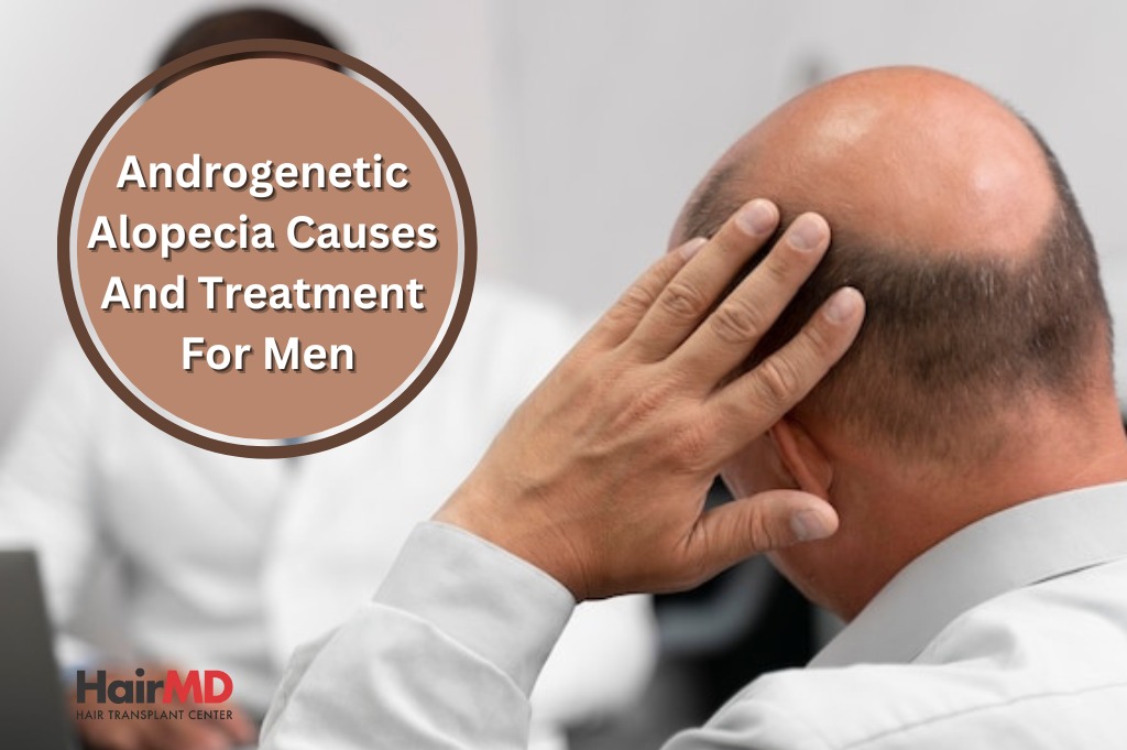 Androgenetic Alopecia Causes and Treatment for Men
