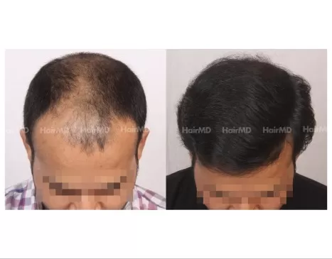 Hair Transplant Results After 12 Months