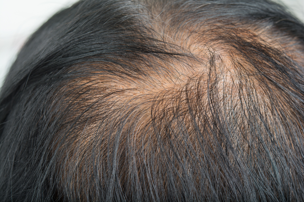 Can Stress Cause Hair Loss? - Toppik Blog