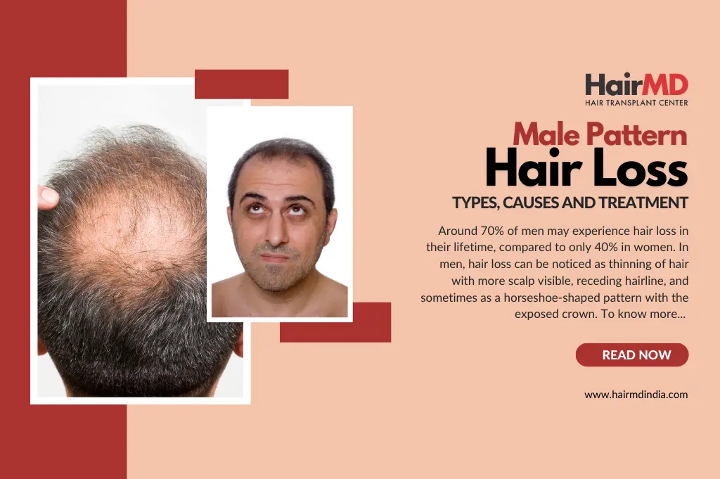 Male Pattern Baldness - A complete Guide