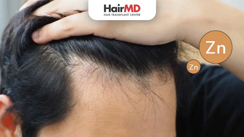 Can Diabetes Cause Hair Loss Expert Insights can-diabetes-cause-hair-loss-expert-insights
