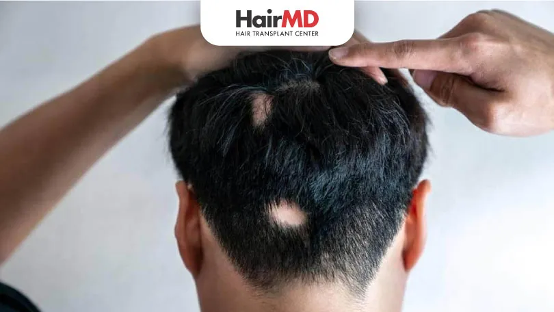 When Does Alopecia Areata Typically Begin? Key Age Insights