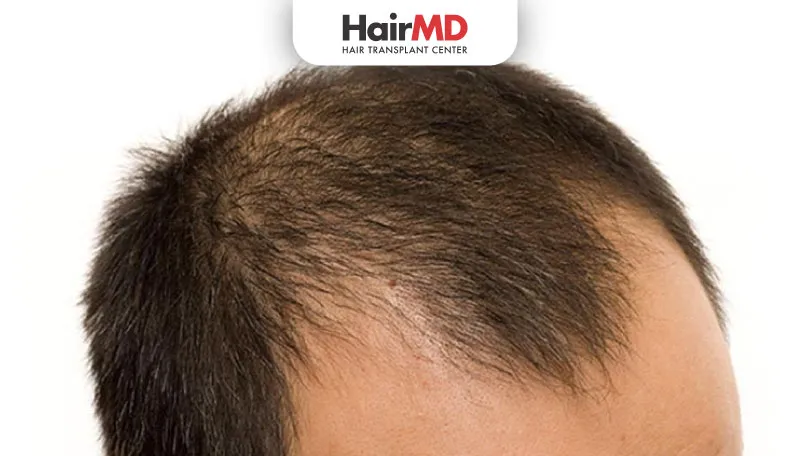 Prevent Baldness in Men