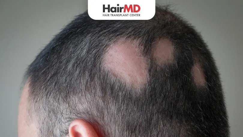 Why Patchy Hair Loss?