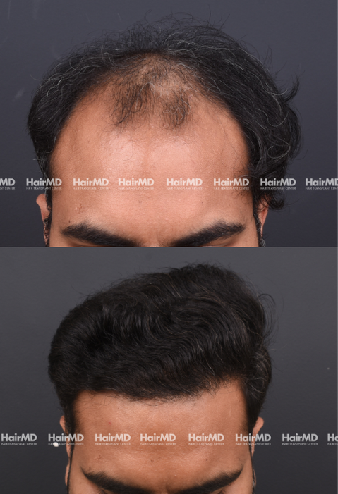 42-year old male Hair Transplant Results 2-Year 4000-5000 Grafts HairMD Pune