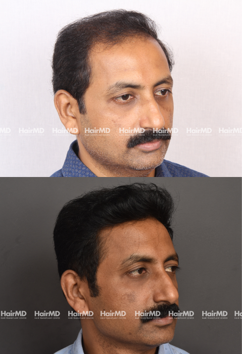 Uday Warke Hair Transplant Results 2 Years 4000-5000Grafts HairMD Pune