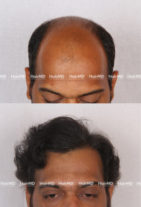 43-year old male Hair Transplant Results 2-Years 5000-6000 Grafts HairMD Pune