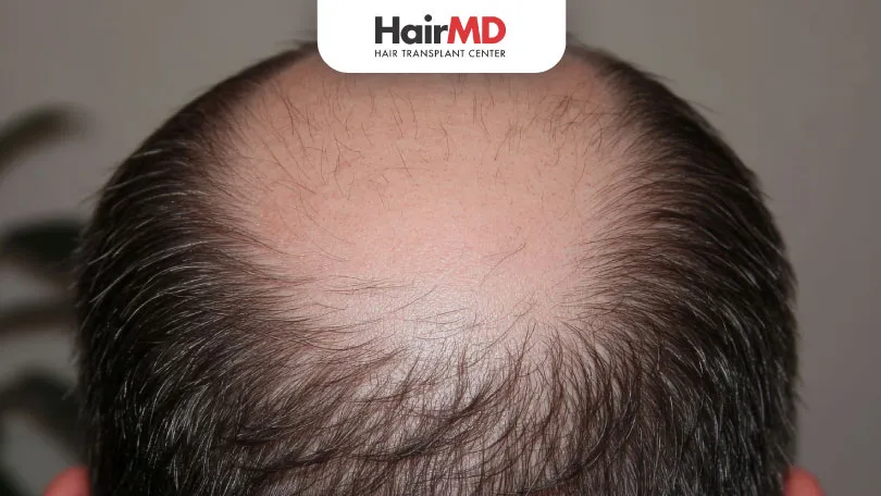 Can-miniaturization-of-hair-follicles-be-reversed