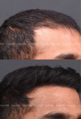 28-years old male Hair Transplant Results 1-Year 3000-4000 Grafts HairMD Pune