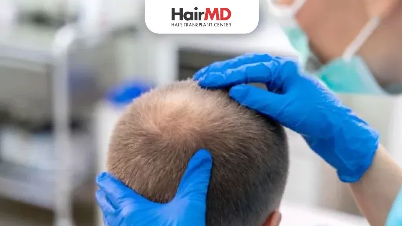 synthetic hair transplant