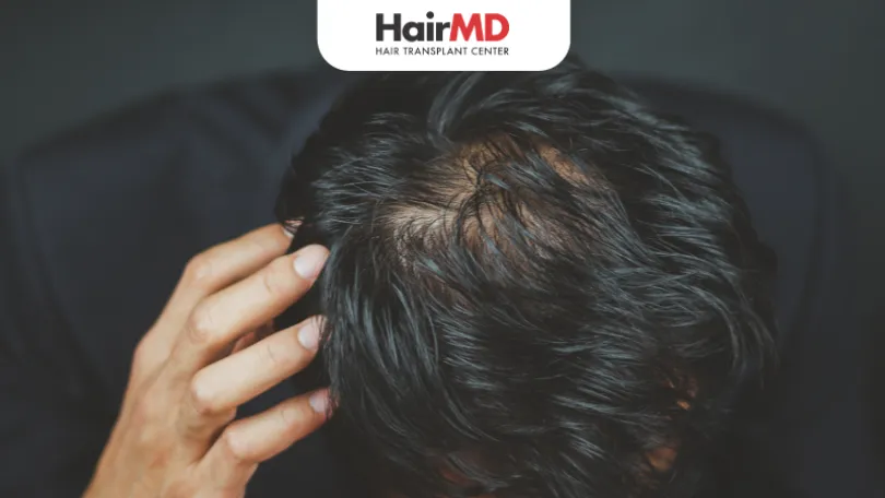 Oily Scalp After Hair Transplant and How to Manage It