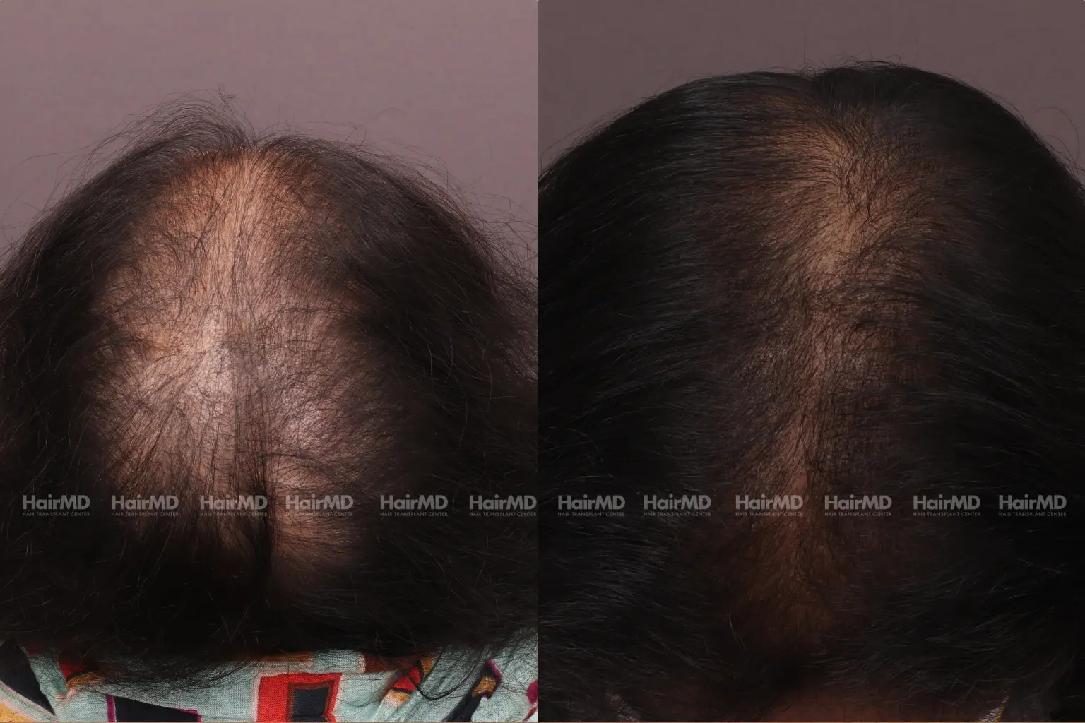Female Hair Loss Before And After Results