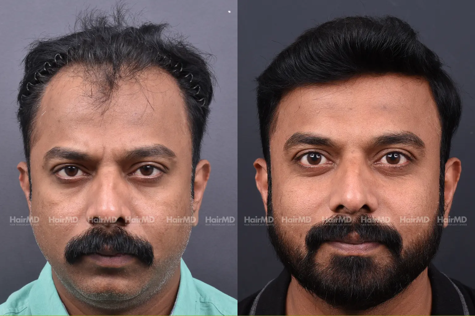 Hair Treatment Results Before And After