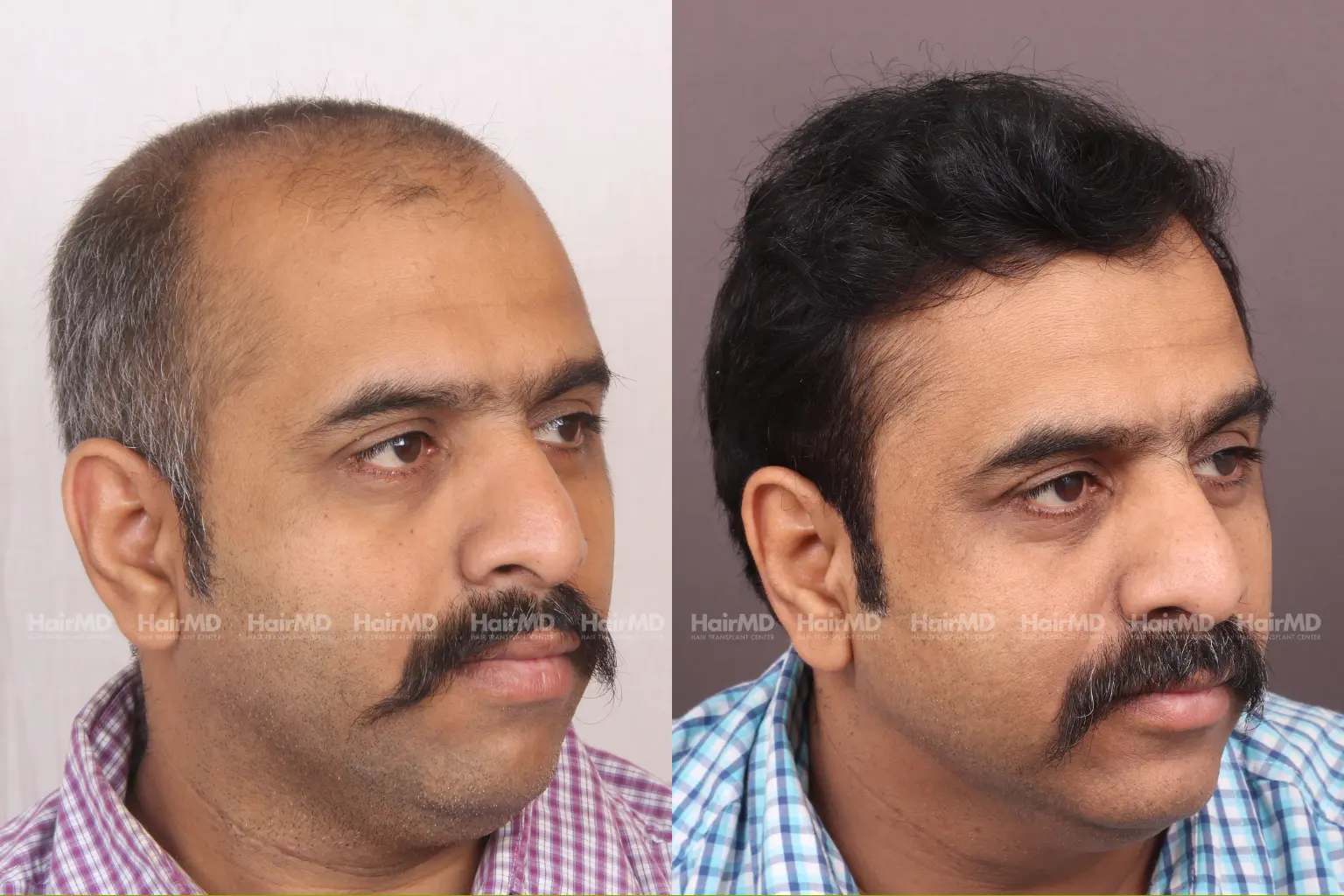 Hair transplant results before and after