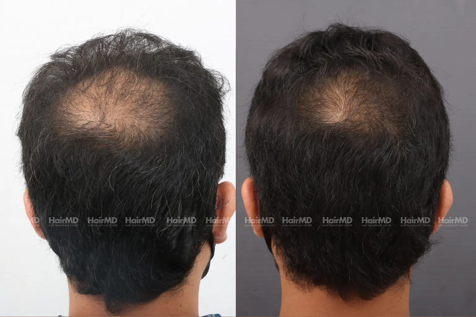 PRP hair treatment results before and after