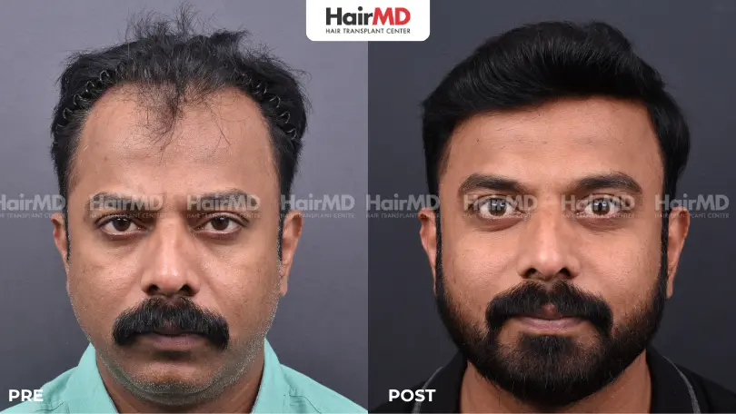 The Advanced Technologies Used for Hair Transplant at HairMD Pune