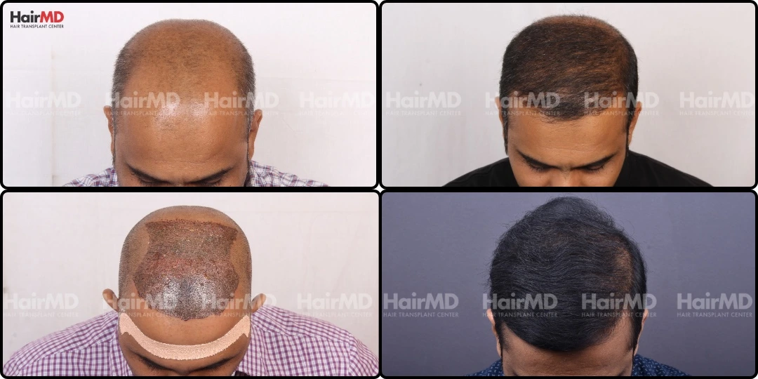 Hair transplant results timeline FUE recovery HairMD