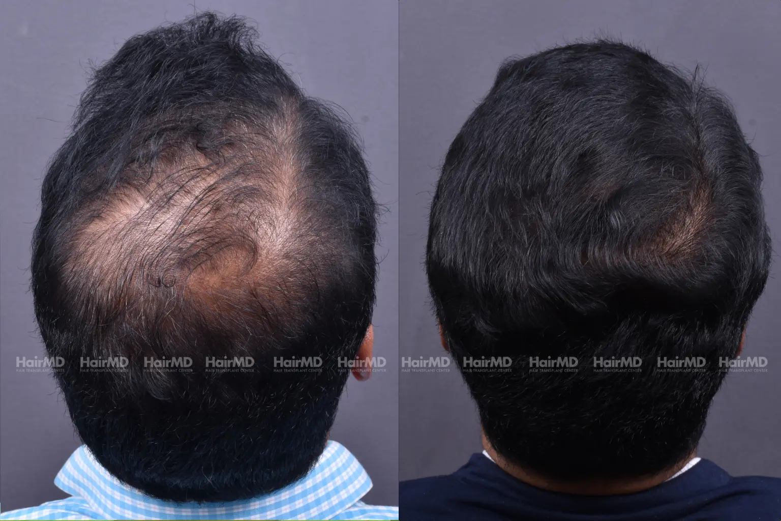 PRP therapy before and after results showing hair density improvement in Pune patient