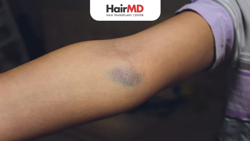 Side Effects of IV Drip Therapy