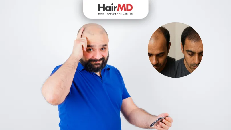 How to Avoid a Bad Hair Transplant