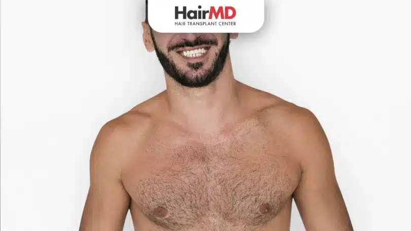 Body Hair Transplant (BHT) in 2026: Using Beard and Chest Hair to Fix a Bald Scalp