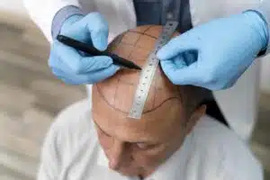 Natural Hairline Design in Hair Transplant