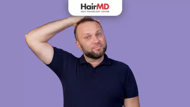 Early Signs of Male Pattern Baldness