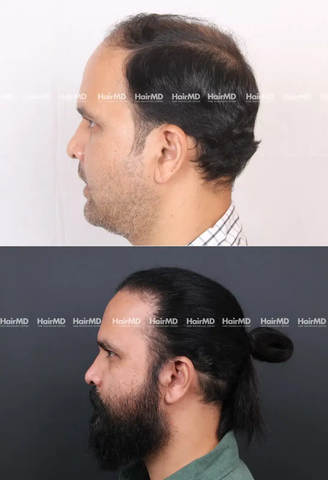 Hair Transplant