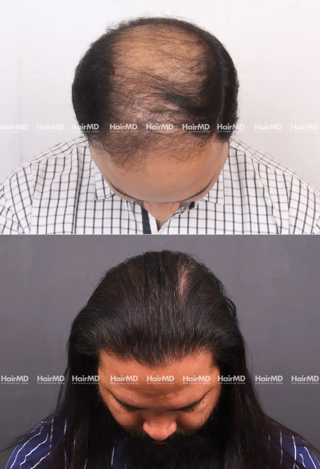 Hair Transplant
