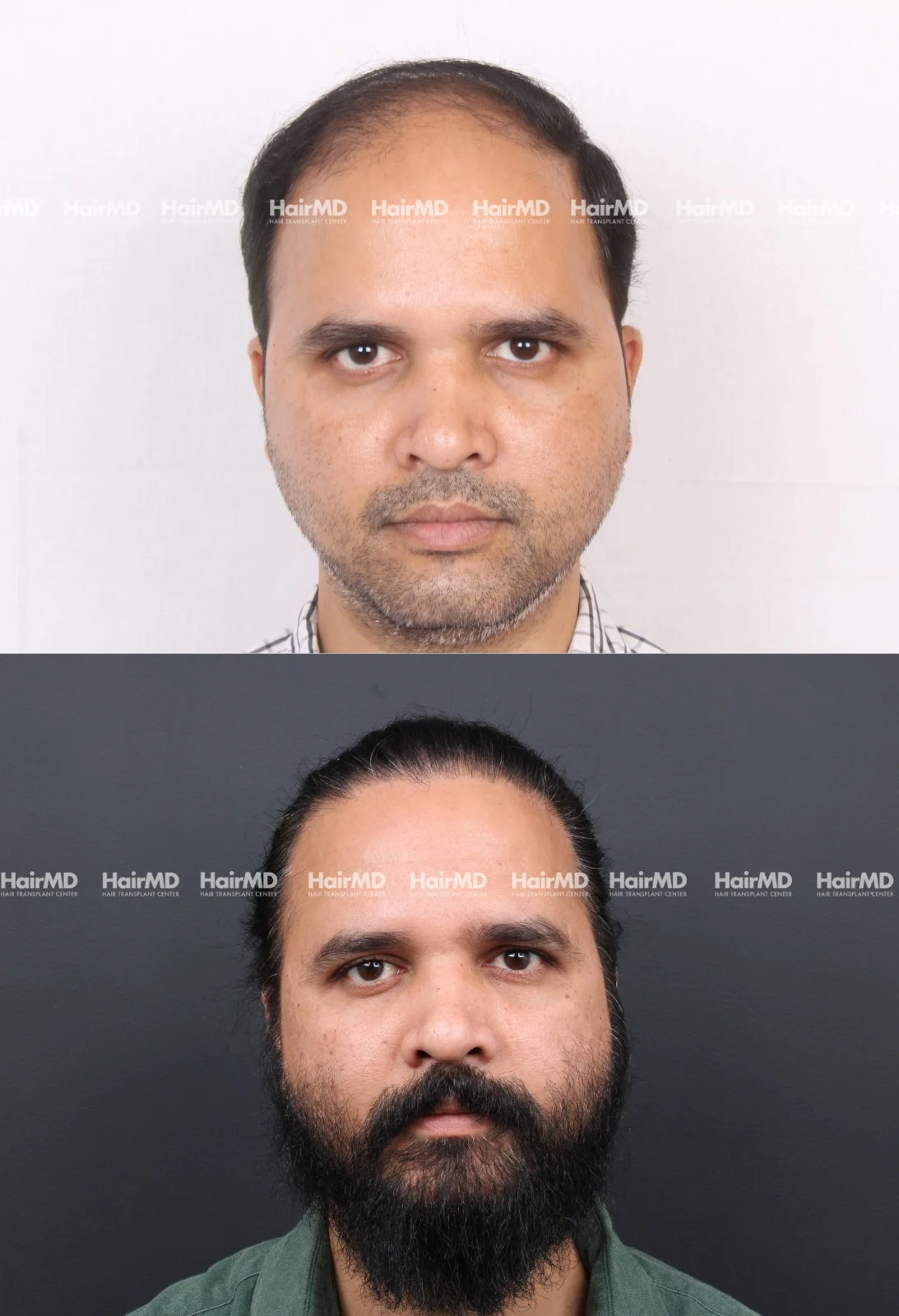 Hair Transplant