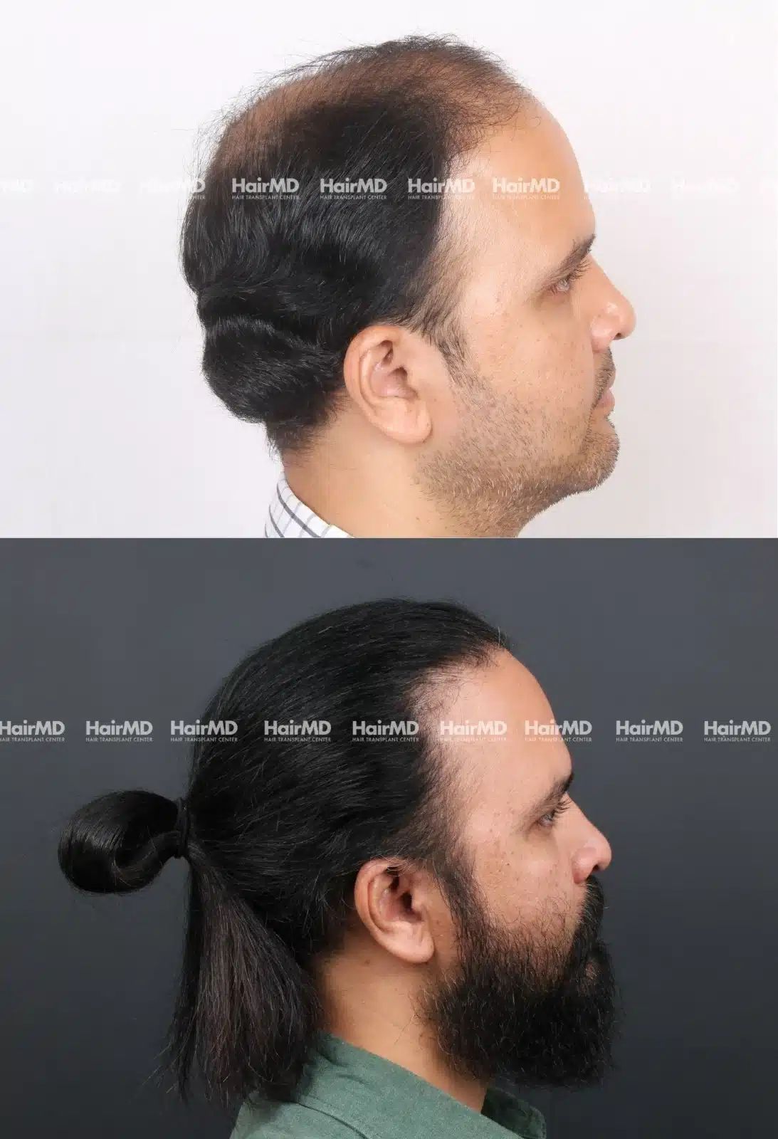 Hair Transplant