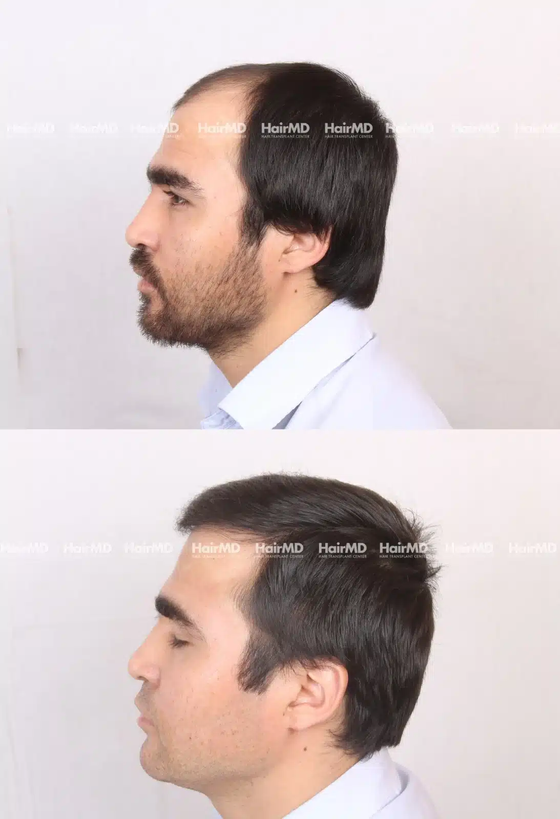 Hair Transplant