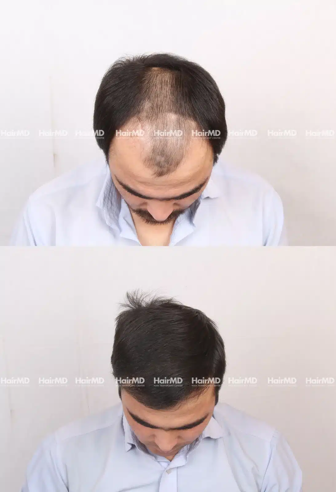 Hair Transplant