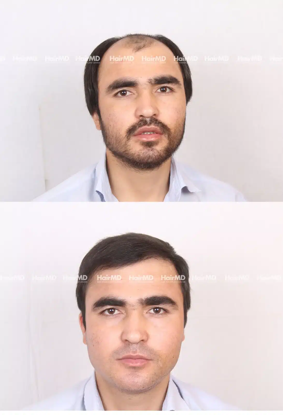 Hair Transplant