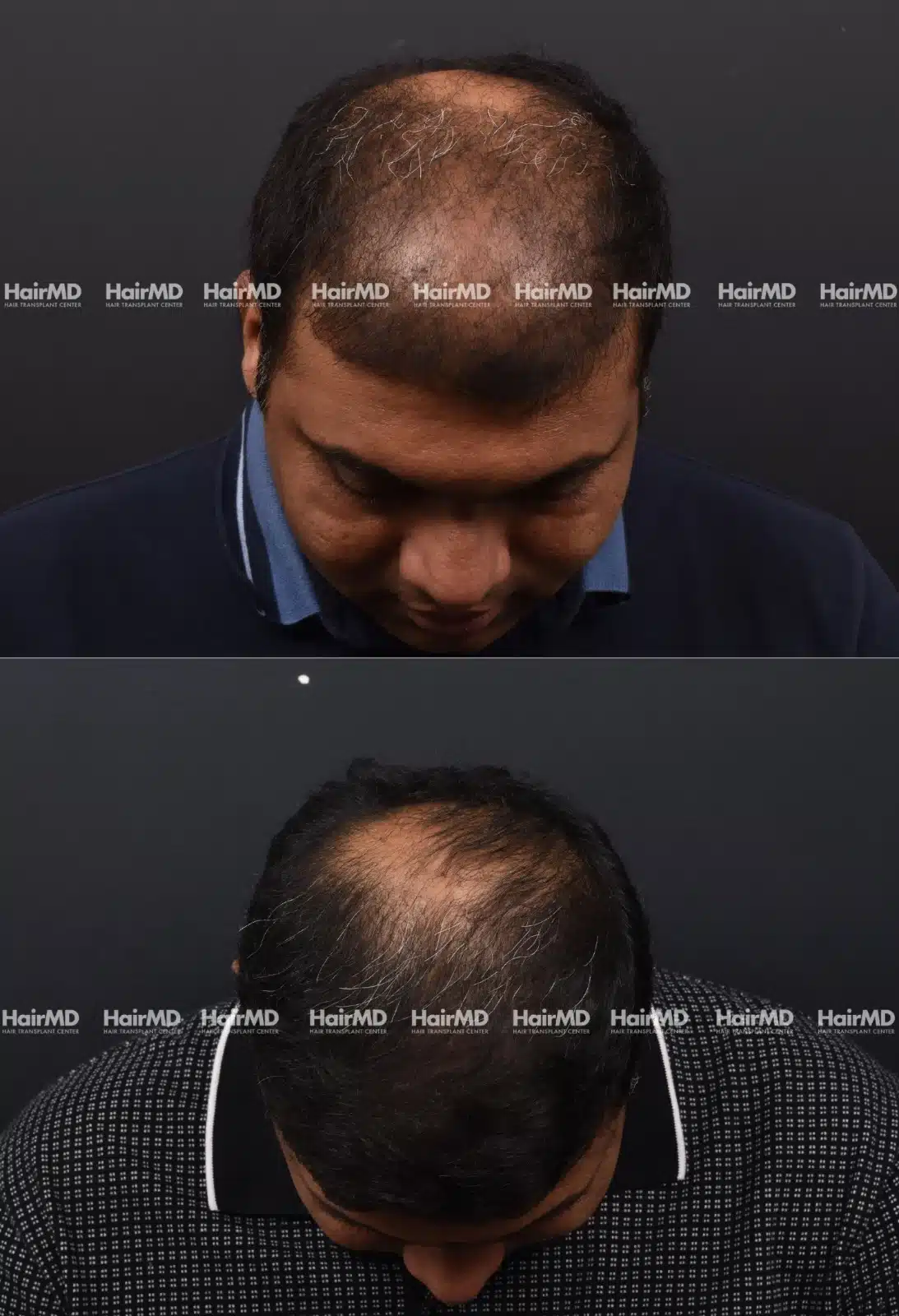 Hair Transplant