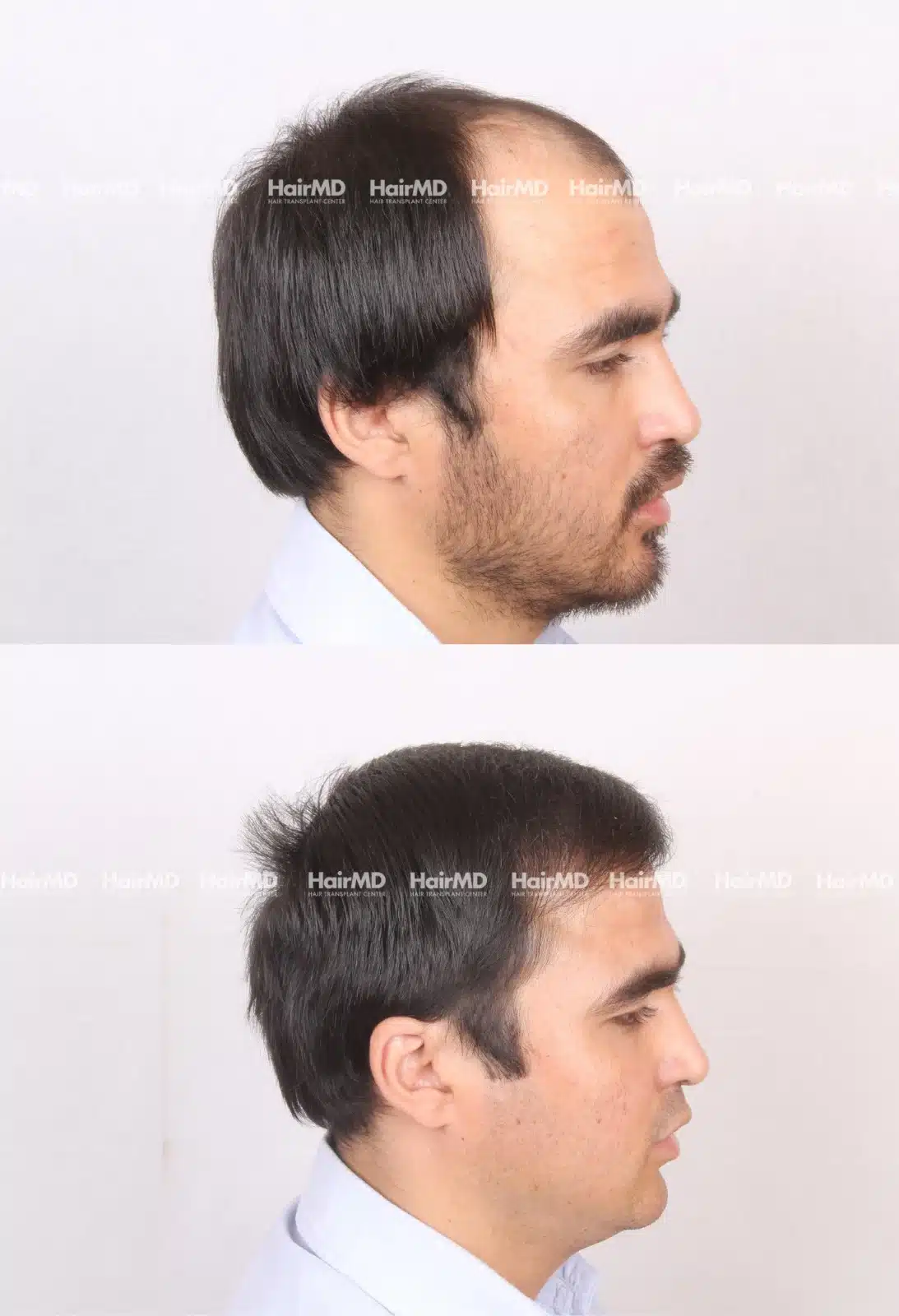 Hair Transplant
