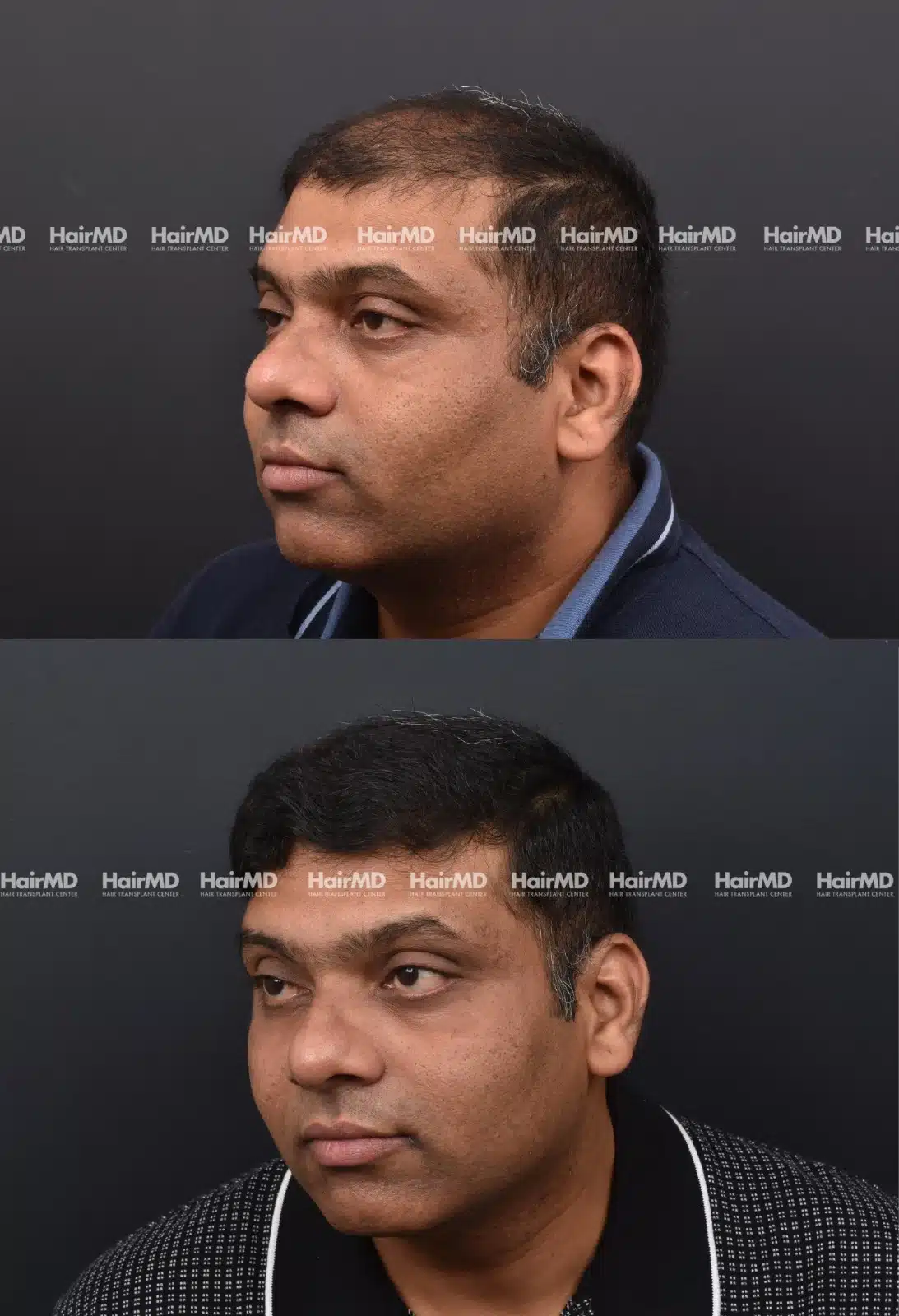 Hair Transplant