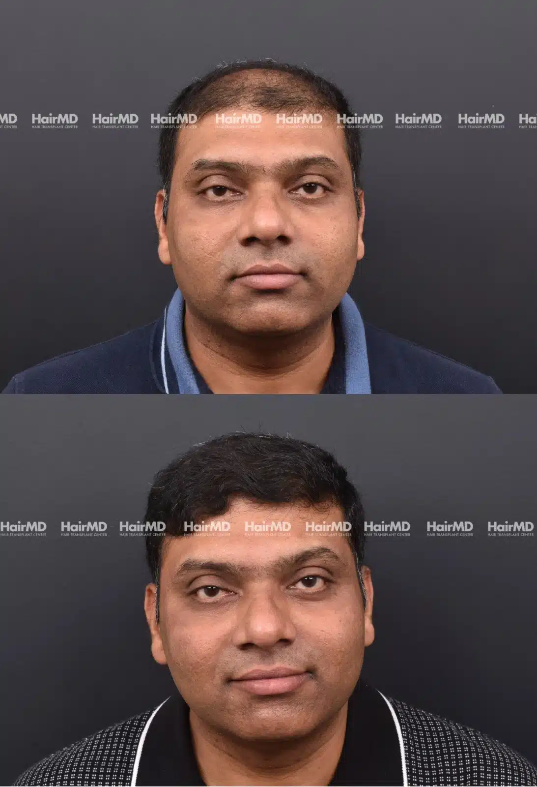 Hair Transplant