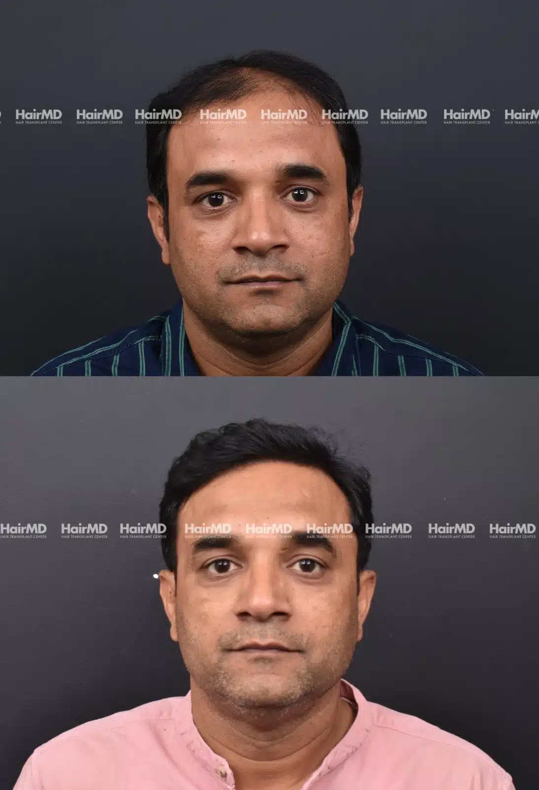 Hair Transplant